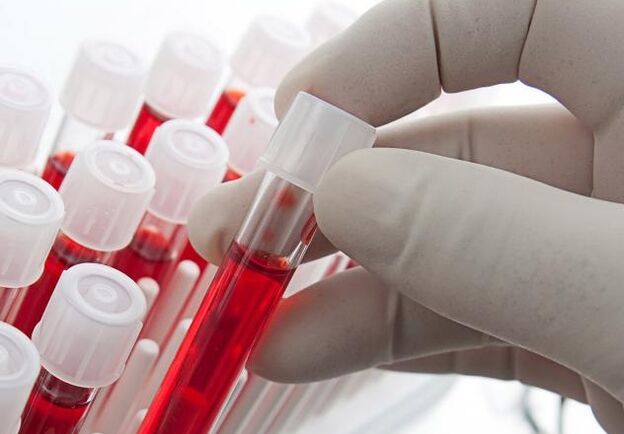 Ичкилик ичкенден кийин кан анализ